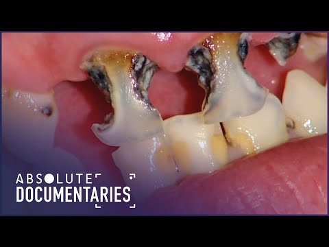 Throwing up Every Day Has Eroded All My Teeth: Britain's Worst Teeth | Absolute Documentaries
